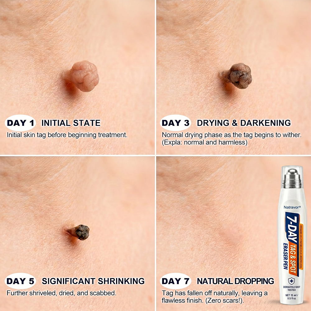 𝐏𝐡𝐚𝐫𝐦𝐚𝐜𝐢𝐬𝐭 𝐑𝐞𝐜𝐨𝐦𝐦𝐞𝐧𝐝𝐞𝐝 🌿🌿Natravor® 7-𝐷𝑎𝑦 𝗧𝐚𝐠 & 𝗦𝗽𝐨𝐭 𝐄𝐫𝒂𝒔𝒆𝒓🪄(Zero 𝐏𝐚𝐢𝐧, Zero 𝐒𝐜𝐚𝒓𝒔 Rollerball)👩‍⚕️